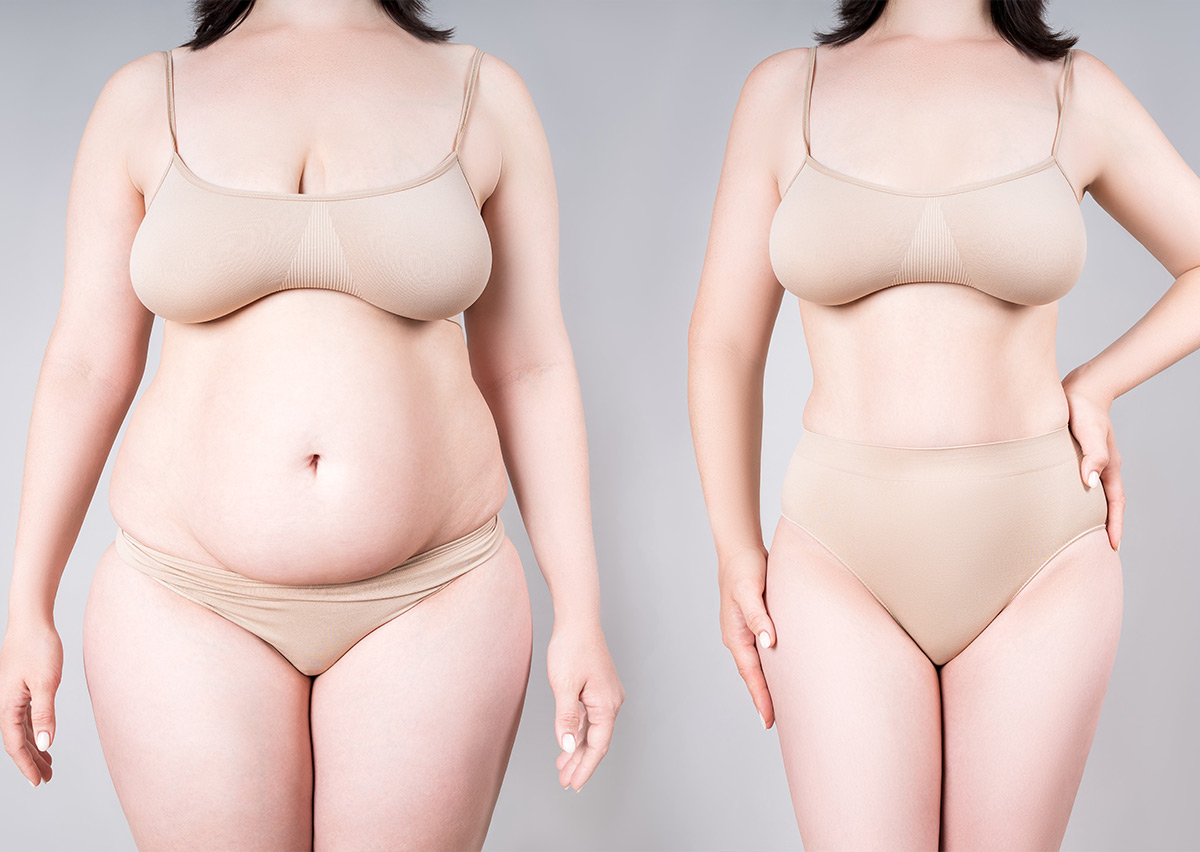  Tummy Tuck surgery or Abdominoplasty in Mumbai
