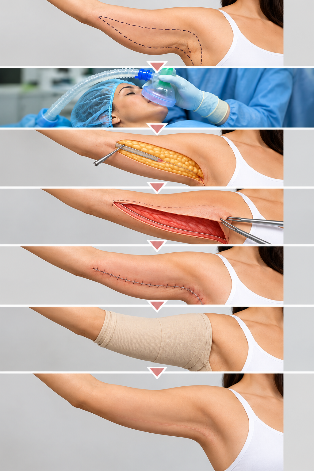 How arm lift surgery (brachioplasty) is performed