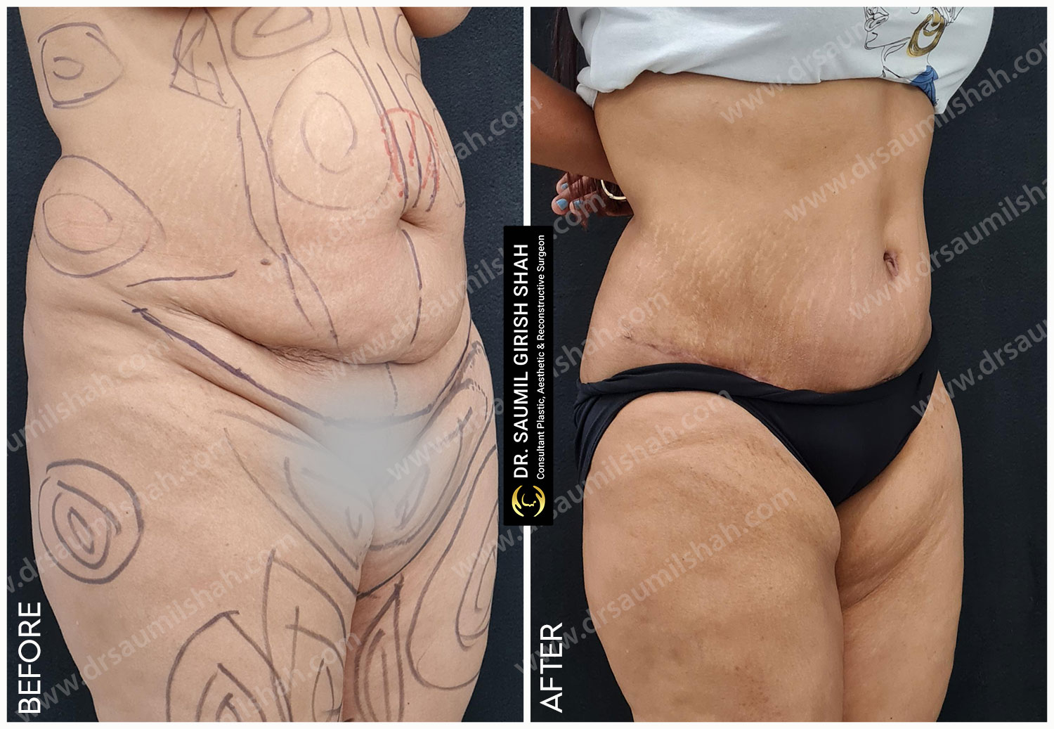 before after View for Tummy Tuck surgery