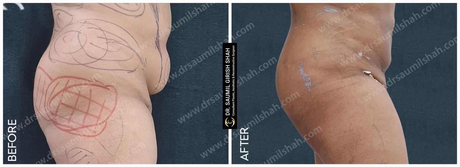 before after View for lipo surgery