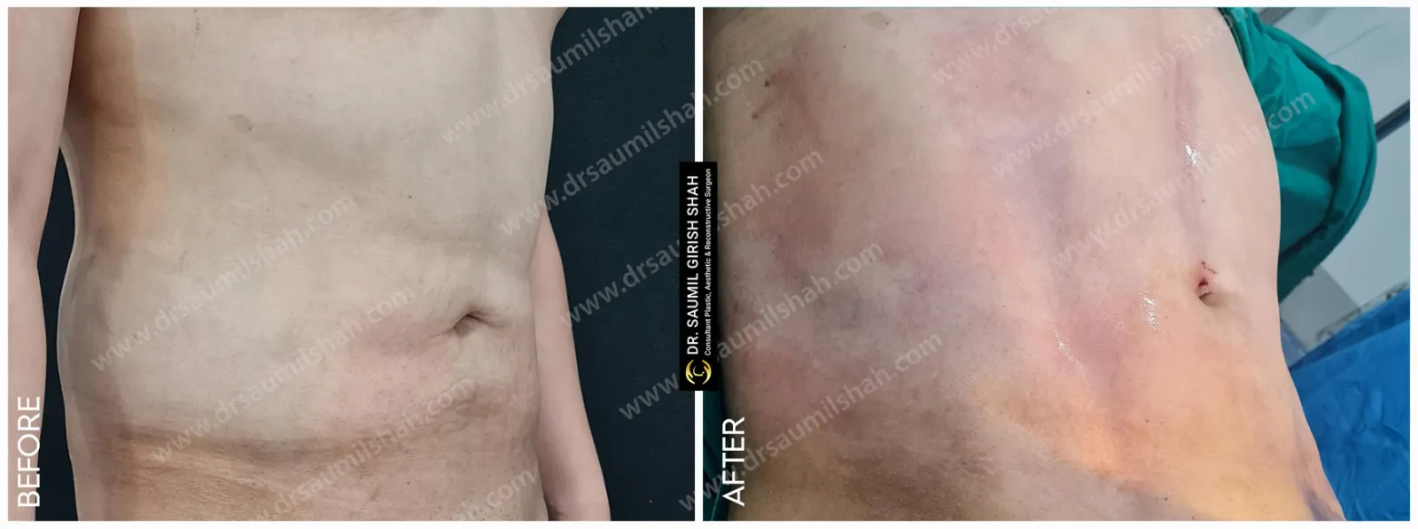 before after View for tummy tuck surgery female
