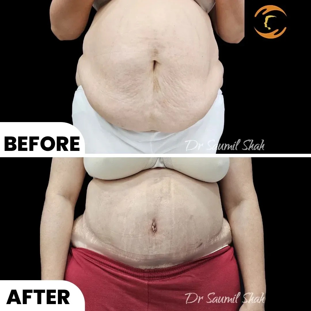 before after View for Tummy Tuck surgery