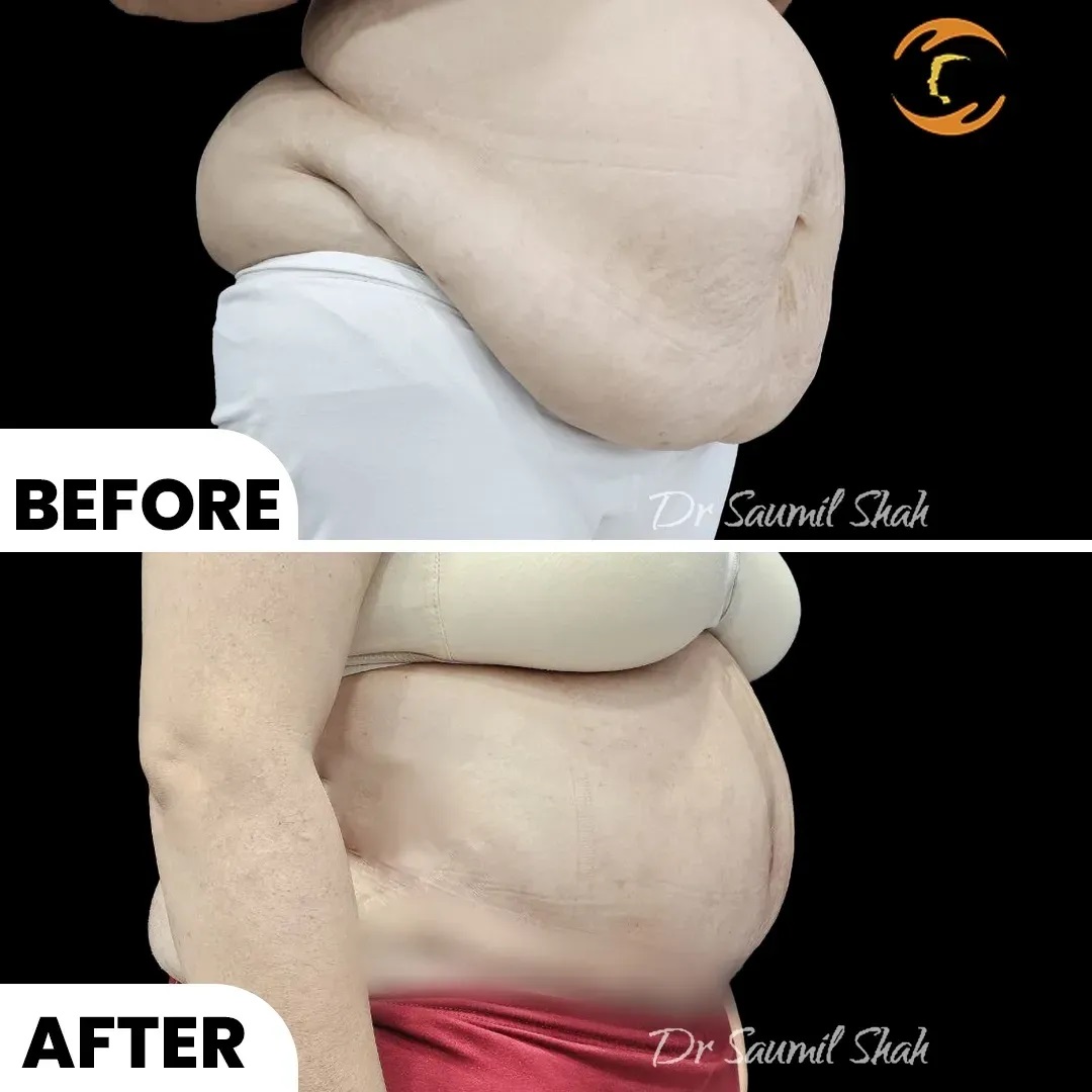 before after View for Tummy Tuck surgery