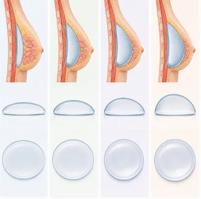 Implant Profiles Explained