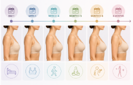 Breast augmentation recovery timeline