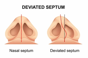 Deviated Septum – What Is It | Dr. Saumil Shah Mumbai