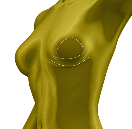 female Breast Augmentation