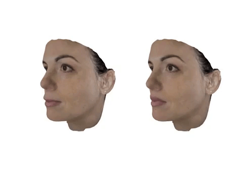 before after 3d face view of surgery