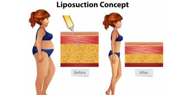 liposuction blog bg