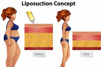 liposuction