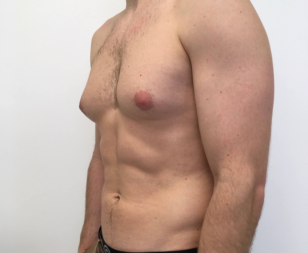 Male Breast reduction Gynecomastia Surgery in Mumbai