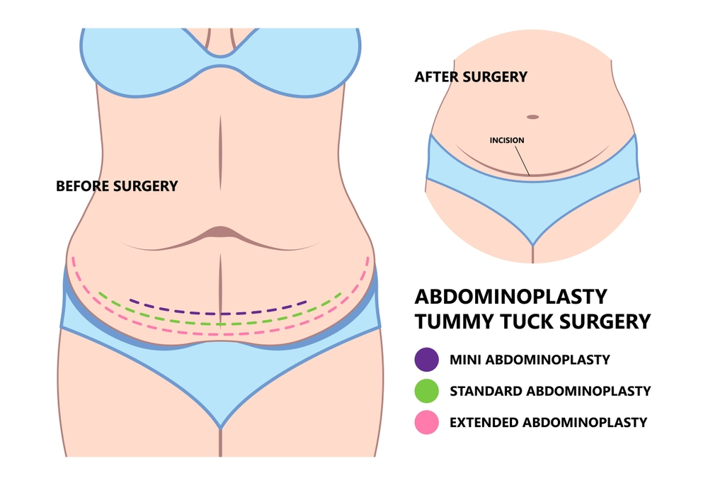 Types of Tummy Tuck/Abdominoplasty surgery in mumbai