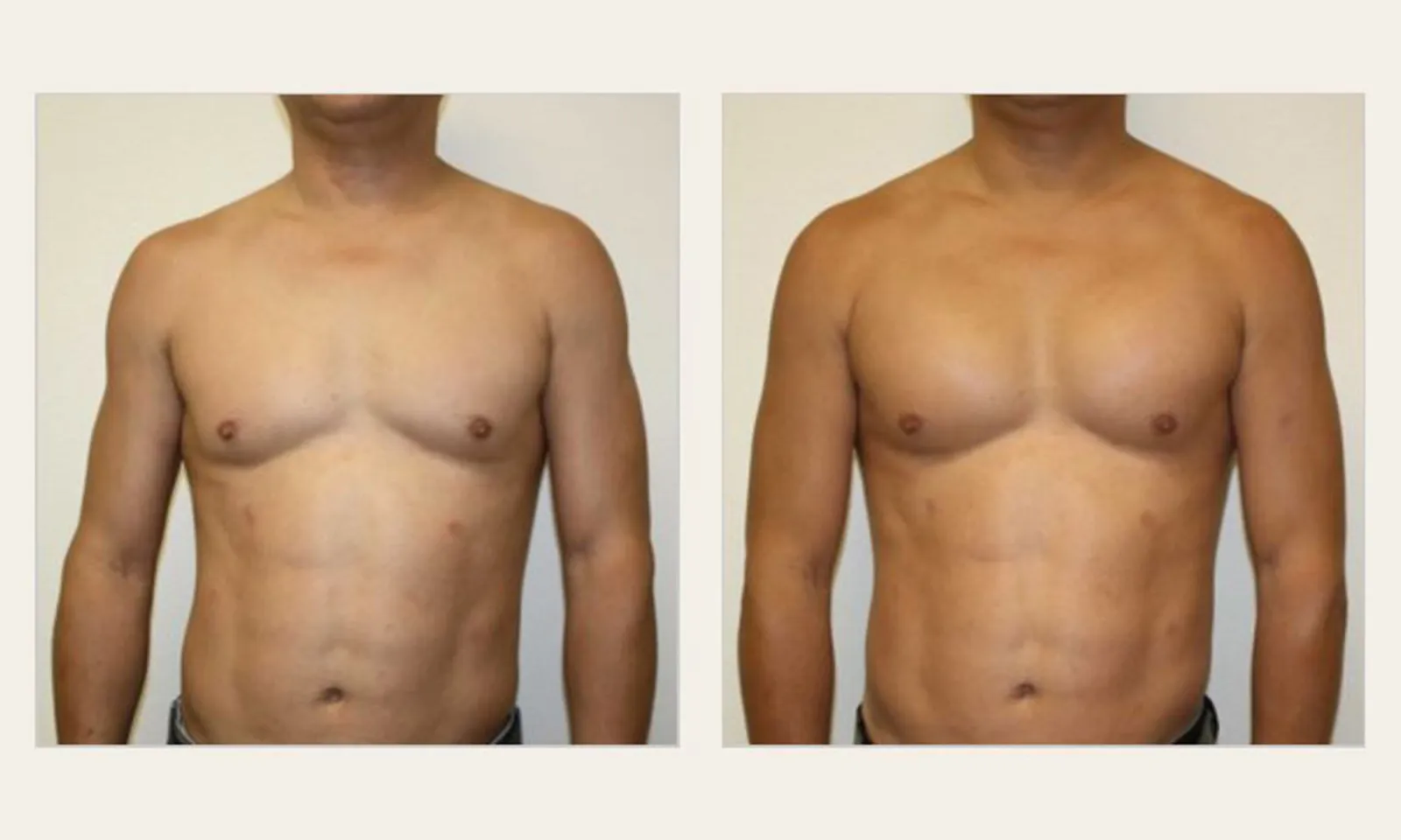 breast male
