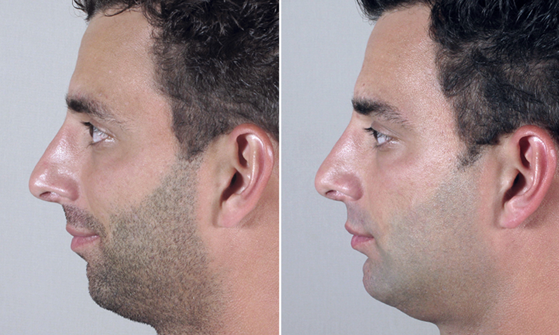 chin augmentation male