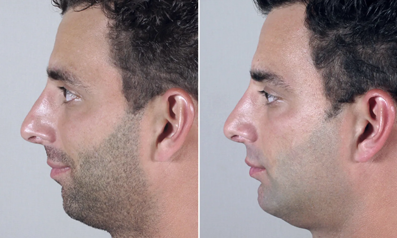 chin augmentation male