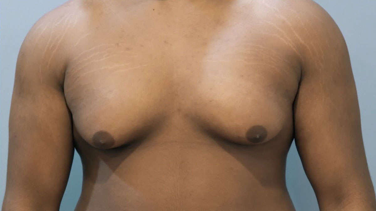 Ideal Candidates for Gynecomastia Surgery in Mumbai