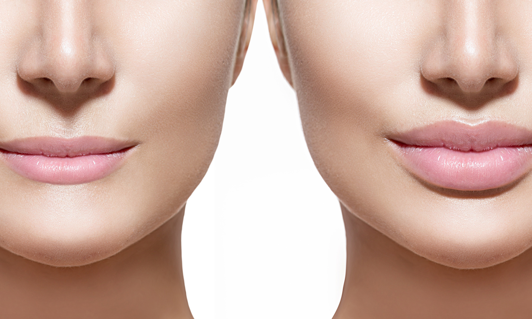 lip augmentation female