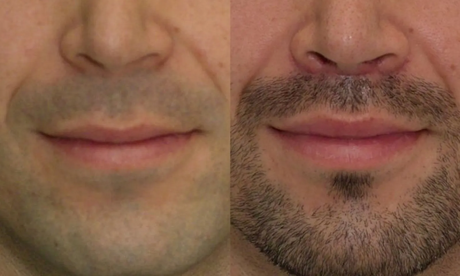 lip augmentation male