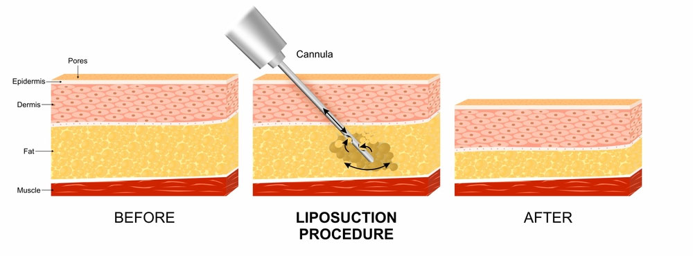 Procedure for Liposuction Surgery in Mumbai