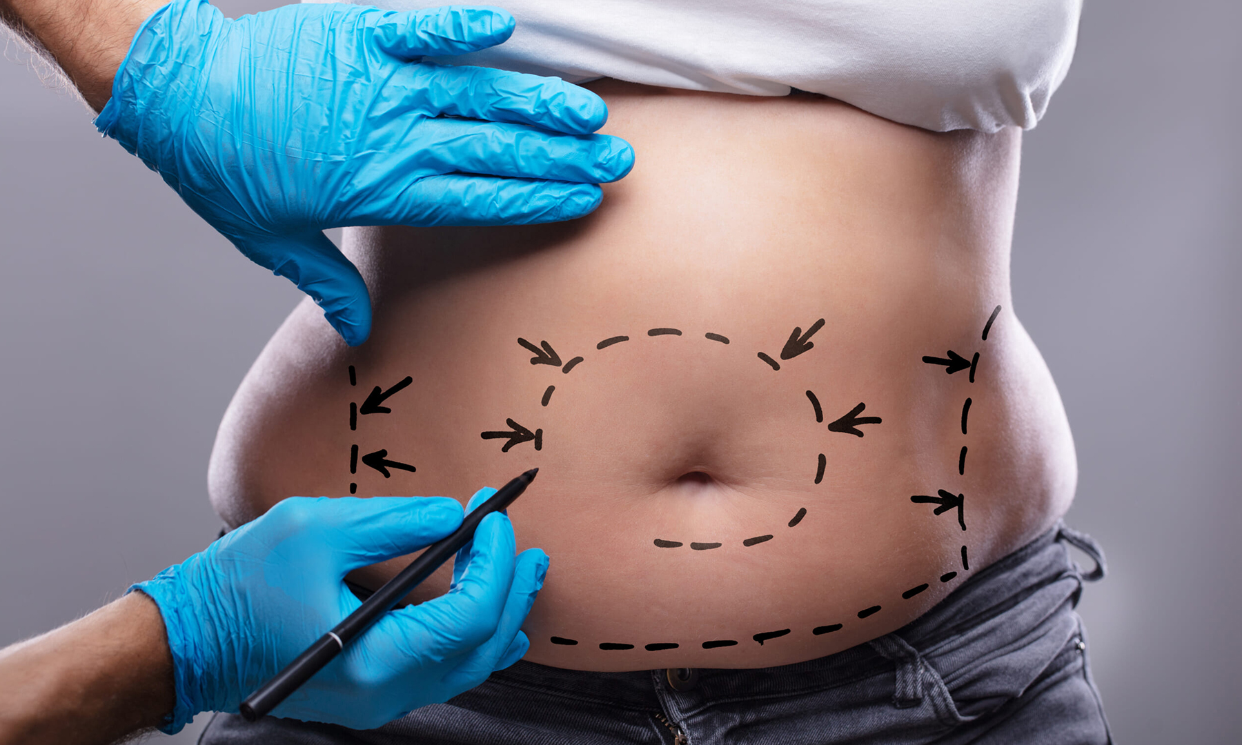 tummy tuck female