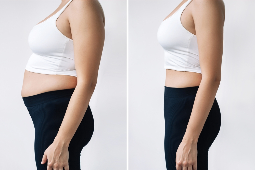Candidates for Liposuction Surgery in Mumbai